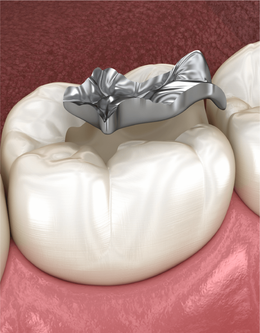 詰め物・被せの提案と選定