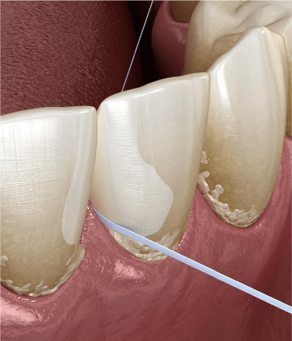 ルートプレーニング