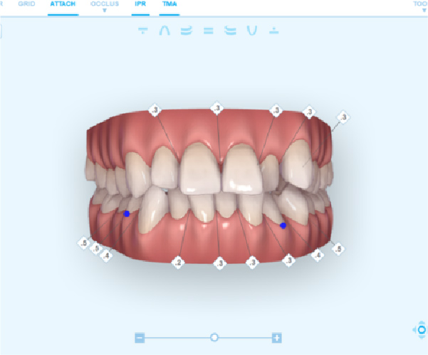 非金属ブラケット